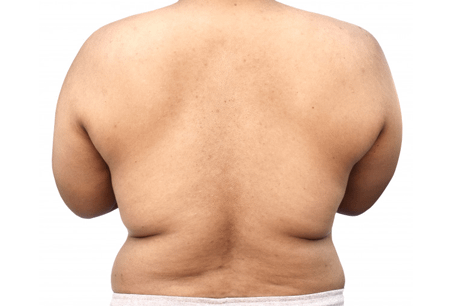 back-fat-removal