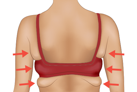 bra-fat-removal